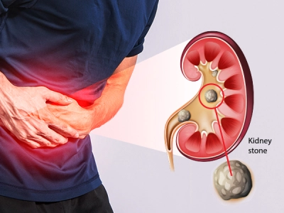 Kidney Stone Kidney Stone